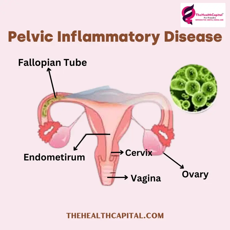 pelvic inflammatory disease - the health capital